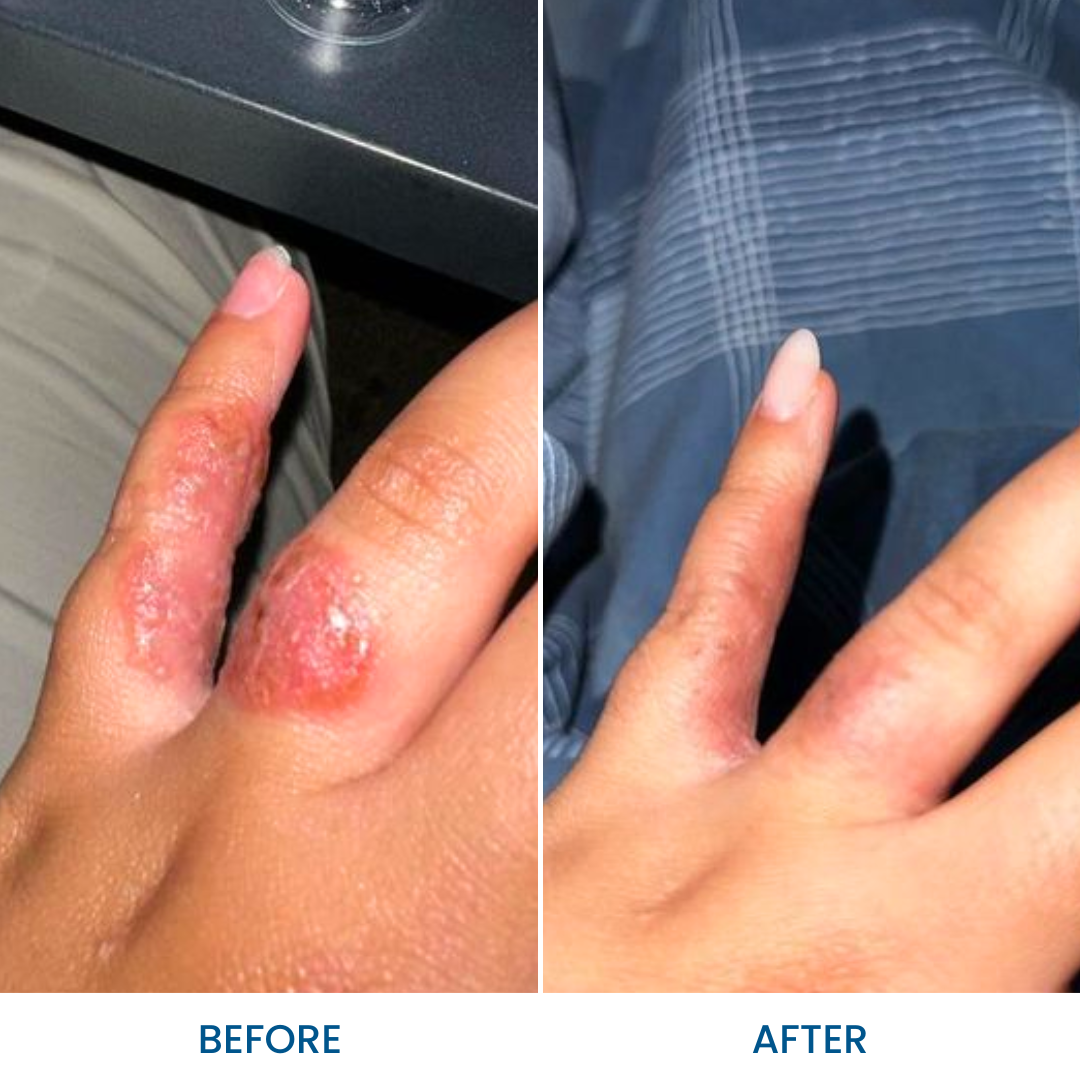 Grahams Natural Eczema Gel, 75g (Exp 07/28)