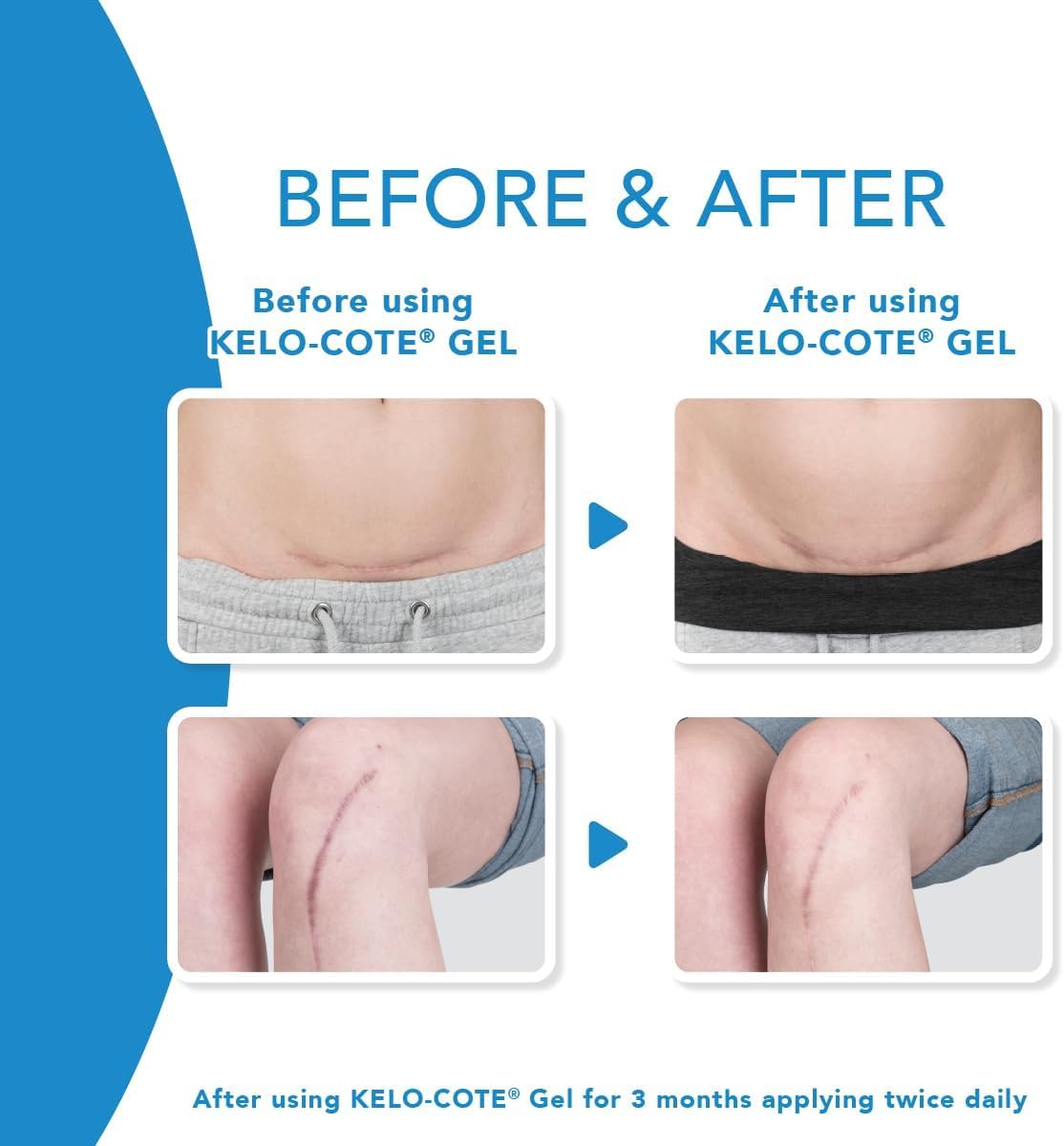 KELO-COTE Silicone Scar Gel, 15g (Exp 07/26)
